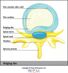 bulging disc,home remedies for back pain South Shore, home remedies for neck pain South Shore, home remedies for back pain Boston, home remedies for neck pain Boston, nonsurgical treatment for back pain south shore, nonsurgical treatment for neck pain south shore, nonsurgical treatment for back pain Boston, nonsurgical treatment for neck pain Boston, spine anatomy library south shore, spine anatomy library boston
