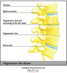 Degenerative disc,home remedies for back pain South Shore, home remedies for neck pain South Shore, home remedies for back pain Boston, home remedies for neck pain Boston, nonsurgical treatment for back pain south shore, nonsurgical treatment for neck pain south shore, nonsurgical treatment for back pain Boston, nonsurgical treatment for neck pain Boston, spine anatomy library south shore, spine anatomy library boston