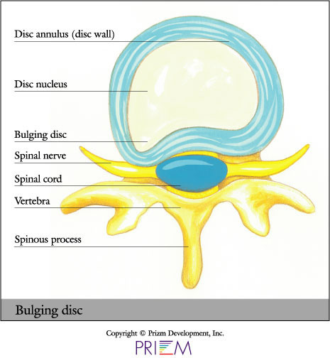 Herniated Disc, Bangor, Ellsworth