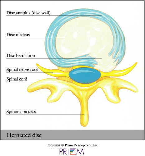 Causes & Treatments of Lumbar Herniated Discs & The Brain - Spine Institute  of North Houston