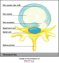 herniated disc,home remedies for back pain South Shore, home remedies for neck pain South Shore, home remedies for back pain Boston, home remedies for neck pain Boston, nonsurgical treatment for back pain south shore, nonsurgical treatment for neck pain south shore, nonsurgical treatment for back pain Boston, nonsurgical treatment for neck pain Boston, spine anatomy library south shore, spine anatomy library boston