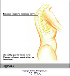 Kyphosis,home remedies for back pain South Shore, home remedies for neck pain South Shore, home remedies for back pain Boston, home remedies for neck pain Boston, nonsurgical treatment for back pain south shore, nonsurgical treatment for neck pain south shore, nonsurgical treatment for back pain Boston, nonsurgical treatment for neck pain Boston, spine anatomy library south shore, spine anatomy library boston