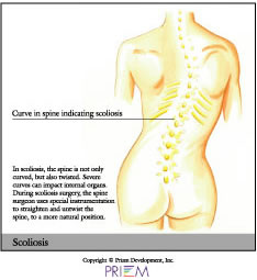 Scoliosis,home remedies for back pain South Shore, home remedies for neck pain South Shore, home remedies for back pain Boston, home remedies for neck pain Boston, nonsurgical treatment for back pain south shore, nonsurgical treatment for neck pain south shore, nonsurgical treatment for back pain Boston, nonsurgical treatment for neck pain Boston, spine anatomy library south shore, spine anatomy library boston